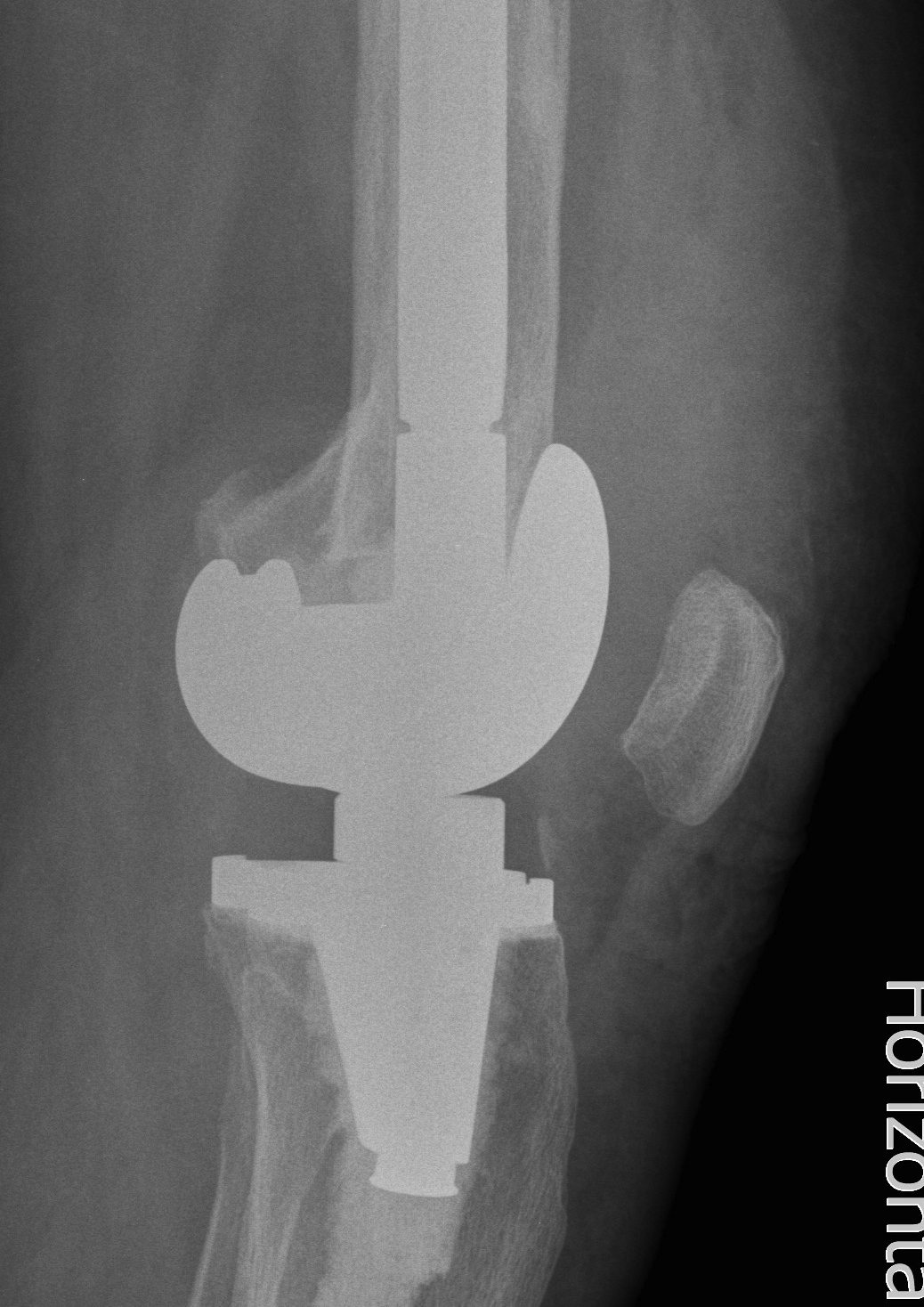 Revision TKR Quadriceps Rupture